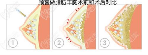 朱云醫(yī)生隆胸負面新聞