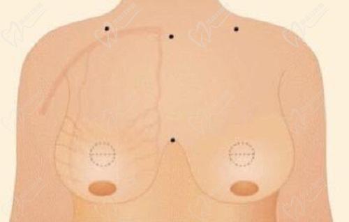 杭州栗勇醫(yī)生做縮胸手術(shù)多少錢？