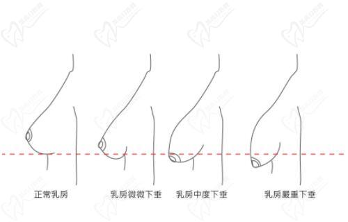 栗勇醫(yī)生縮胸隆胸技術(shù)特別好