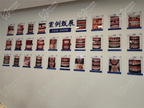 四、固德口腔種植牙的價(jià)格明細(xì)