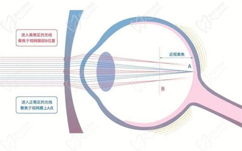 三、 全優(yōu)學(xué)鏡片成效評估：臨床研究與用戶反饋綜合分析
